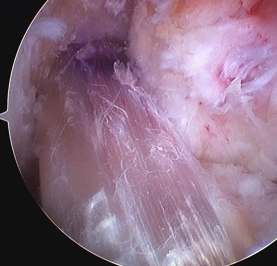 ACL Hamstring Autograft Arthroscopy